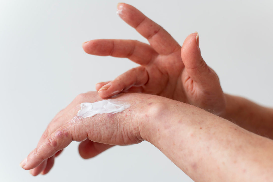 Quick Relief for Minor Burns Using Ozone Products