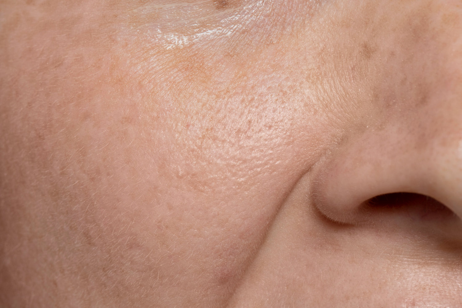 dry skin 