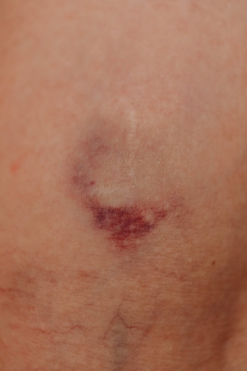 Ozone and Bruising